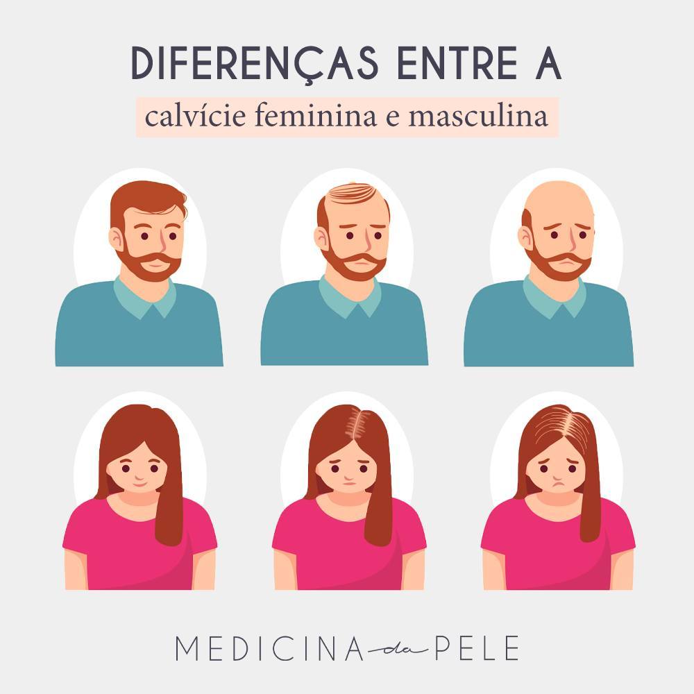 Diferenças entre a calvície feminina e masculina
