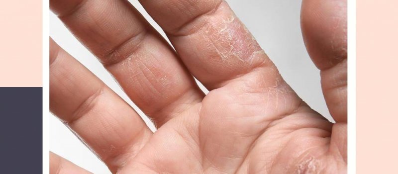 Dermatite de mãos