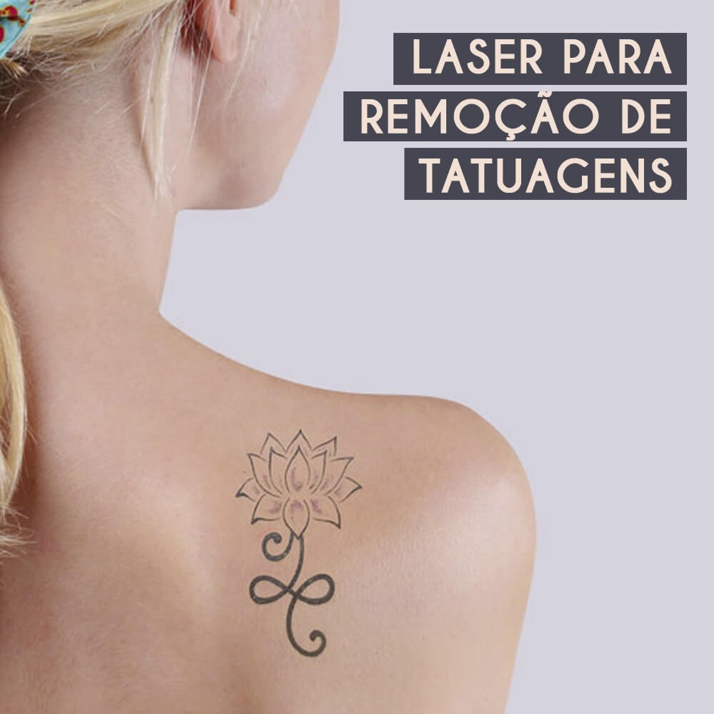 Laser para remoção de tatuagens