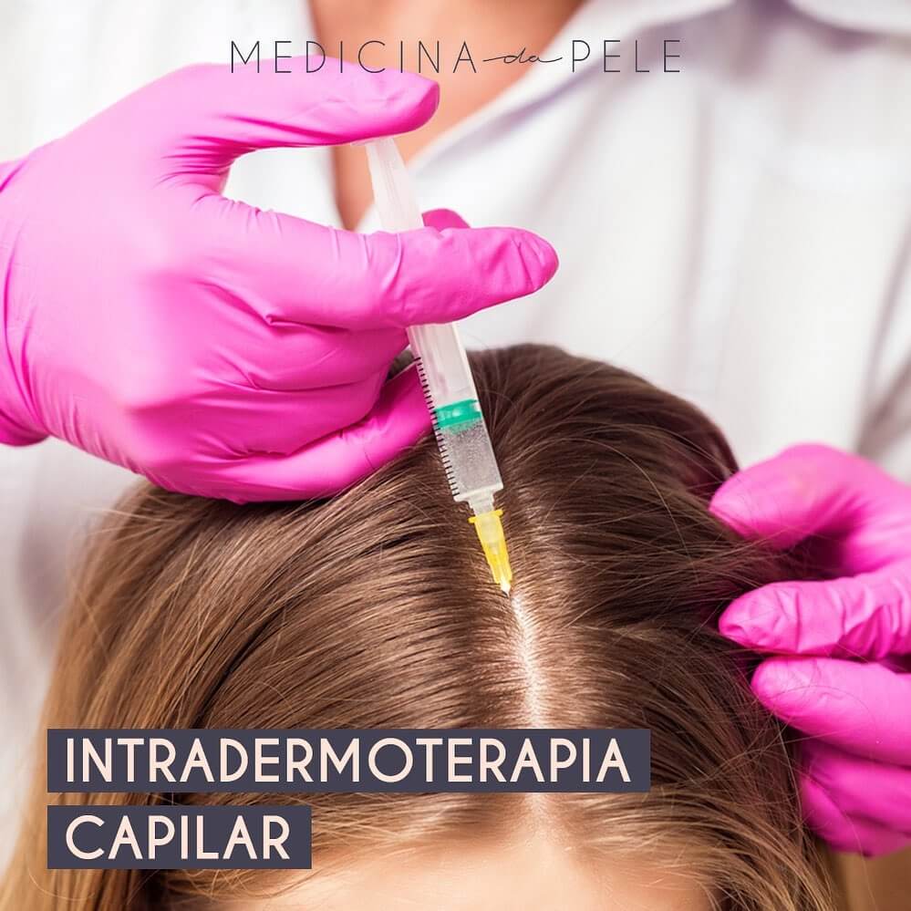 Intradermoterapia capilar