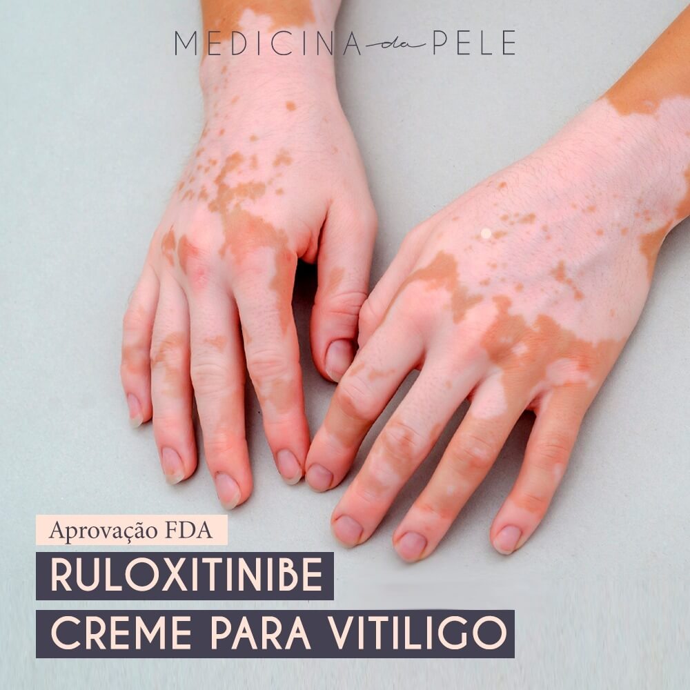 Ruloxitinibe creme para o tratamento do vitiligo
